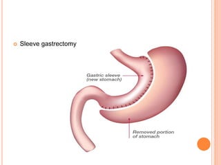  Sleeve gastrectomy
 