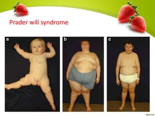 Prader wili syndrome
 