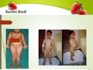 Bardet-Biedl
 