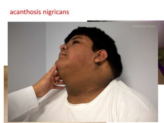 acanthosis nigricans
 