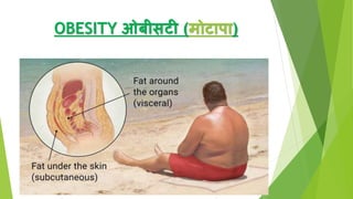 OBESITY ओबीसटी (मोटापा)
 