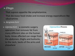 Drugs:
 That supress appetite like amphetamine.
 That decrease food intake and increase energy expenditure like
sibutramine.
 Acupuncture
 Liposuction : a cosmetic surgery
operation that removes fat from
many different sites on the human
body. Areas affected can range from
the abdomen, thighs and buttocks,
to the neck, backs of the arms and
elsewhere.
 