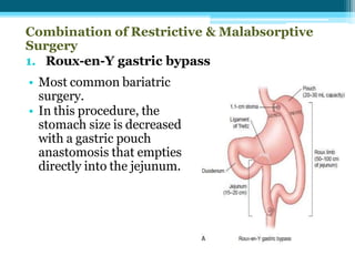 Combination of Restrictive & Malabsorptive
Surgery
1. Roux-en-Y gastric bypass
• Most common bariatric
surgery.
• In this procedure, the
stomach size is decreased
with a gastric pouch
anastomosis that empties
directly into the jejunum.
 