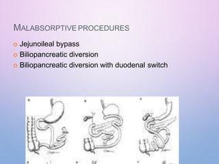MALABSORPTIVE PROCEDURES
 Jejunoileal bypass
 Biliopancreatic diversion
 Biliopancreatic diversion with duodenal switch
 