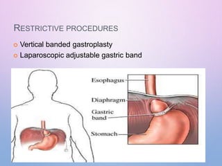 RESTRICTIVE PROCEDURES
 Vertical banded gastroplasty
 Laparoscopic adjustable gastric band
 
