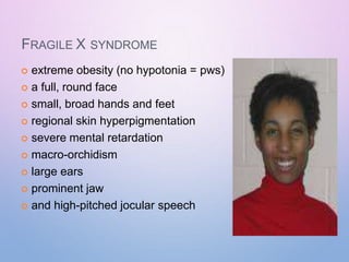 FRAGILE X SYNDROME
 extreme obesity (no hypotonia = pws)
 a full, round face
 small, broad hands and feet
 regional skin hyperpigmentation
 severe mental retardation
 macro-orchidism
 large ears
 prominent jaw
 and high-pitched jocular speech
 