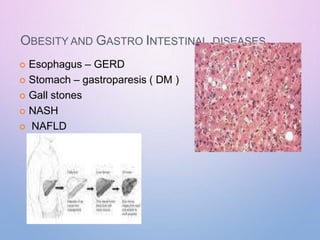 OBESITY AND GASTRO INTESTINAL DISEASES
 Esophagus – GERD
 Stomach – gastroparesis ( DM )
 Gall stones
 NASH
 NAFLD
 