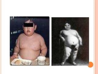 MONOGENIC HUMAN OBESITY
 In the past five years several human disorders of
energy balance that arise from genetic defects...