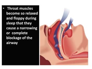 • Throat muscles
become so relaxed
and floppy during
sleep that they
cause a narrowing
or complete
blockage of the
airway

 