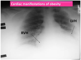 Cardiac manifestations of obesity

LVH
RVH

 