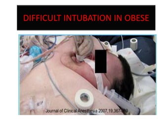 DIFFICULT INTUBATION IN OBESE

 