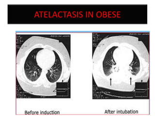 ATELACTASIS IN OBESE

 