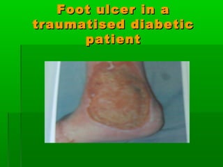 Foot ulcer in aFoot ulcer in a
traumatised diabetictraumatised diabetic
patientpatient
 