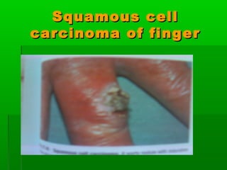Squamous cellSquamous cell
carcinoma of fingercarcinoma of finger
 