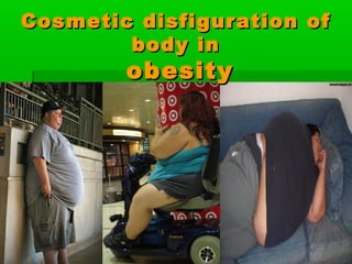 Cosmetic disfiguration ofCosmetic disfiguration of
body inbody in
obesityobesity
 