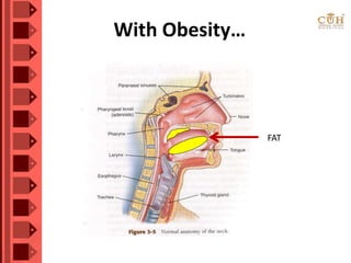 With Obesity…
FAT
 