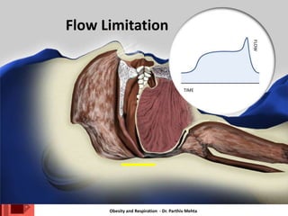 Obesity and Respiration - Dr. Parthiv Mehta
Flow Limitation
TIME
FLOW
 