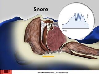 Obesity and Respiration - Dr. Parthiv Mehta
Snore
FLOW
TIME
 