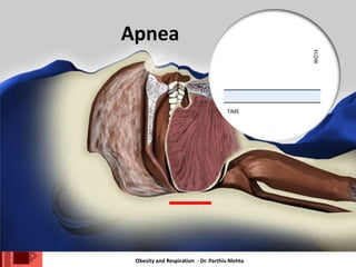 Obesity and Respiration - Dr. Parthiv Mehta
Apnea
TIME
FLOW
 