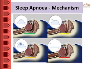 Sleep Apnoea - Mechanism
 
