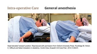 Intra-operative Care General anesthesia
 
