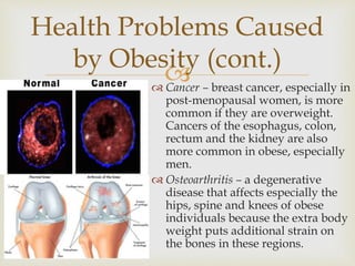  Cancer – breast cancer, especially in
post-menopausal women, is more
common if they are overweight.
Cancers of the esophagus, colon,
rectum and the kidney are also
more common in obese, especially
men.
 Osteoarthritis – a degenerative
disease that affects especially the
hips, spine and knees of obese
individuals because the extra body
weight puts additional strain on
the bones in these regions.
Health Problems Caused
by Obesity (cont.)
 