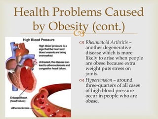 
 Rheumatoid Arthritis –
another degenerative
disease which is more
likely to arise when people
are obese because extra
weight puts stress on
joints.
 Hypertension – around
three-quarters of all cases
of high blood pressure
occur in people who are
obese.
Health Problems Caused
by Obesity (cont.)
 