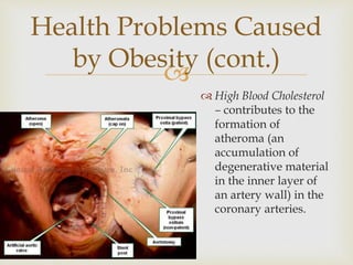 
 High Blood Cholesterol
– contributes to the
formation of
atheroma (an
accumulation of
degenerative material
in the inner layer of
an artery wall) in the
coronary arteries.
Health Problems Caused
by Obesity (cont.)
 
