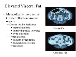 Elevated Visceral Fat
• Metabolically more active
• Greater effect on visceral
organs
– Greater Insulin Resistance
• hyperinsulinemia
• impaired glucose tolerance
• Type 2 diabetes
– Hyperlipidemia
• Hypertriglyceridemia
• Hypercholesterolemia
– Hypertension

Normal Fat

Abnormal Fat

 