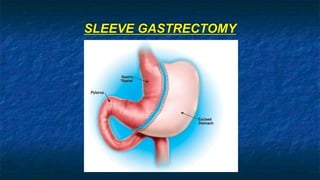 SLEEVE GASTRECTOMY
 