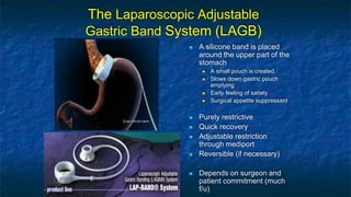 The Laparoscopic Adjustable
Gastric Band System (LAGB)
 A silicone band is placed
around the upper part of the
stomach
 A small pouch is created
 Slows down gastric pouch
emptying
 Early feeling of satiety
 Surgical appetite suppressant
 Purely restrictive
 Quick recovery
 Adjustable restriction
through mediport
 Reversible (if necessary)
 Depends on surgeon and
patient commitment (much
f/u)
 