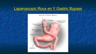 Laparoscopic Roux en Y Gastric Bypass
 