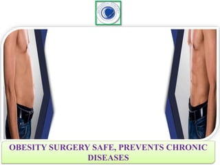 OBESITY SURGERY SAFE, PREVENTS CHRONIC
DISEASES
 