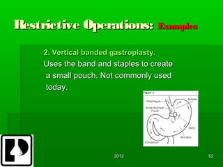 Restrictive Operations: Examples
     2. Vertical banded gastroplasty.
     Uses the band and staples to create
     a small pouch. Not commonly used
     today.




                         2012              52
 