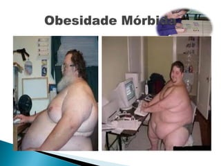 Obessidade