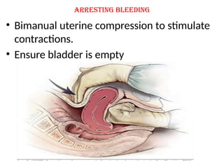 Arresting bleeding
• Bimanual uterine compression to stimulate
contractions.
• Ensure bladder is empty
 
