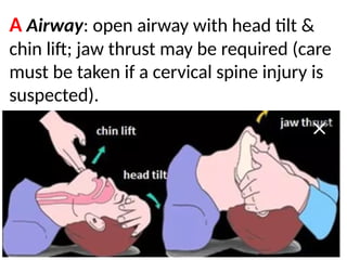 .
A Airway: open airway with head tilt &
chin lift; jaw thrust may be required (care
must be taken if a cervical spine injury is
suspected).
 