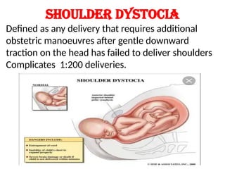 Shoulder dystocia
Defined as any delivery that requires additional
obstetric manoeuvres after gentle downward
traction on the head has failed to deliver shoulders
Complicates 1:200 deliveries.
 