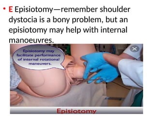 .
• E Episiotomy—remember shoulder
dystocia is a bony problem, but an
episiotomy may help with internal
manoeuvres.
 