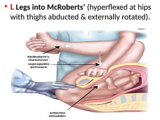 .
• L Legs into McRoberts’ (hyperflexed at hips
with thighs abducted & externally rotated).
 