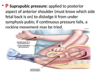 .
• P Suprapubic pressure: applied to posterior
aspect of anterior shoulder (must know which side
fetal back is on) to dislodge it from under
symphysis pubis; if continuous pressure fails, a
rocking movement may be tried.
 