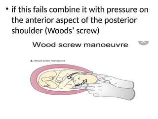 .
• if this fails combine it with pressure on
the anterior aspect of the posterior
shoulder (Woods’ screw)
 