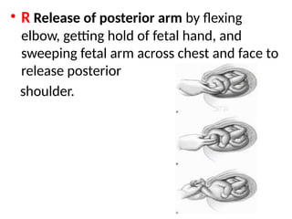 .
• R Release of posterior arm by flexing
elbow, getting hold of fetal hand, and
sweeping fetal arm across chest and face to
release posterior
shoulder.
 