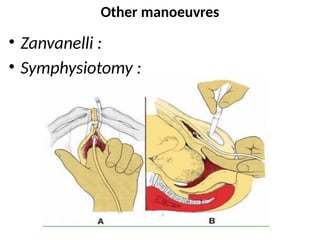 Other manoeuvres
• Zanvanelli :
• Symphysiotomy :
 