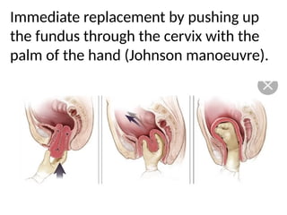 .
Immediate replacement by pushing up
the fundus through the cervix with the
palm of the hand (Johnson manoeuvre).
 