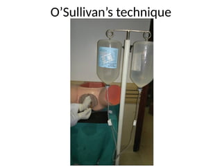O’Sullivan’s technique
 