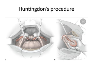 Huntingdon’s procedure
 