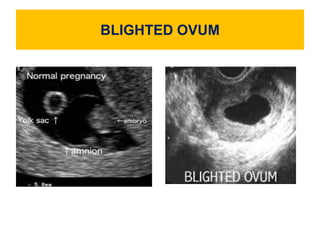 BLIGHTED OVUM
 