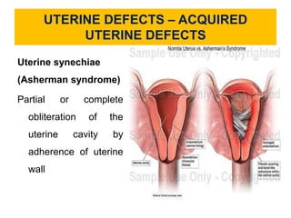 UTERINE DEFECTS – ACQUIRED
UTERINE DEFECTS
Uterine synechiae
(Asherman syndrome)
Partial or complete
obliteration of the
uterine cavity by
adherence of uterine
wall
 