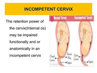 INCOMPETENT CERVIX
The retention power of
the cervix(Internal os)
may be impaired
functionally and or
anatomically in an
incompetent cervix
 